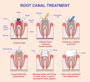 A Step By Step Guide To Root Canal Treatment