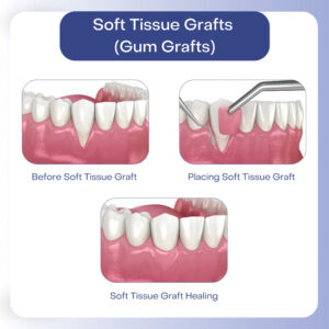 For Gum Grafts