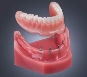 Immediate Dentures In Buffalo NY Same Day Implant Retained Denture Dr. Todd Shatkin
