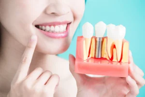 Take Care Of Your Implant Tooth