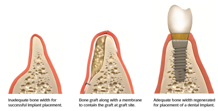 Bonegraft2