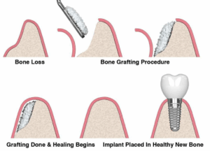Dental Bone Graft Procedure For Dental Implant