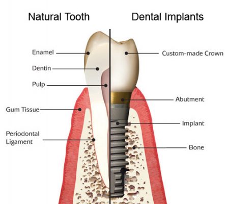 dental implant 302 1