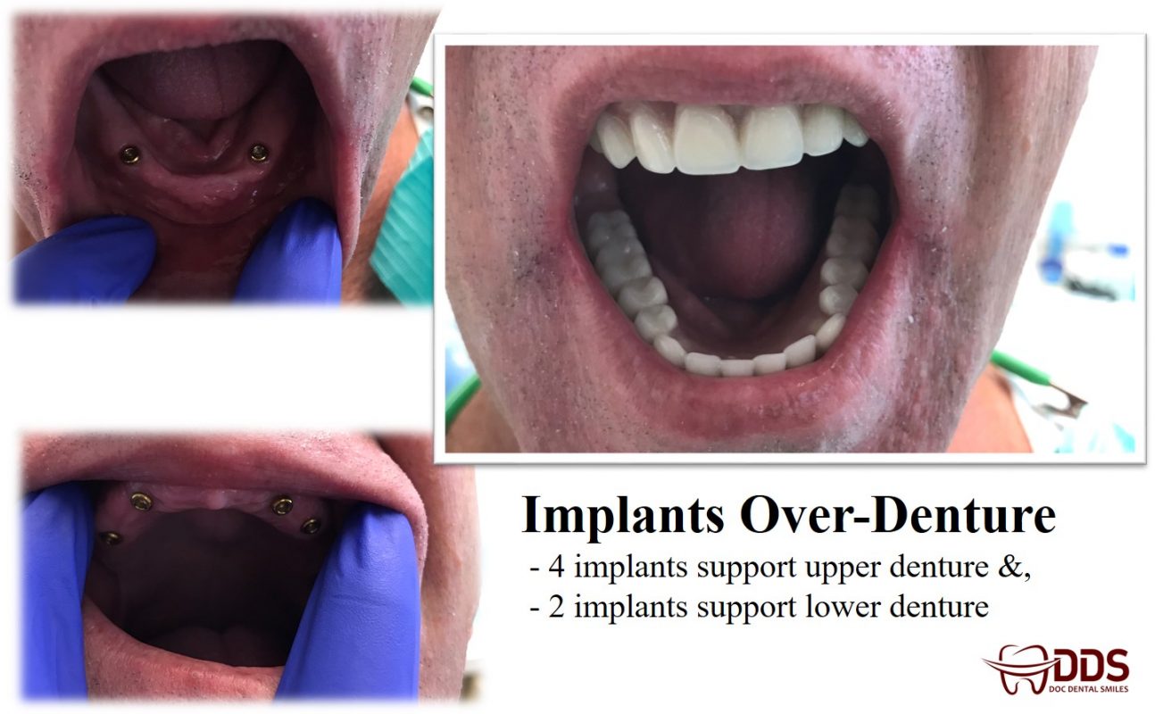 dentures partial dentures 411