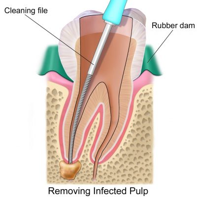 root canal treatment 404 2