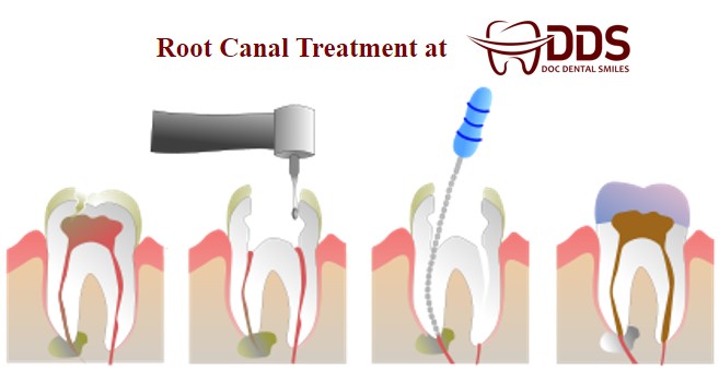 Root Canal Trreatment At DDS