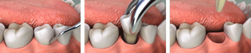 Teeth Extraction Content 800x171