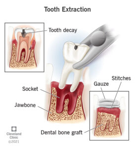 Tooth Extraction